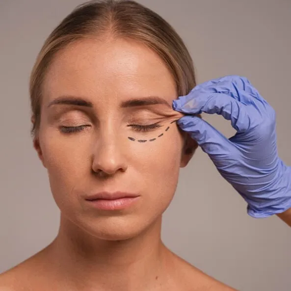 Marcação da pálpebra de uma paciente antes da blefaroplastia